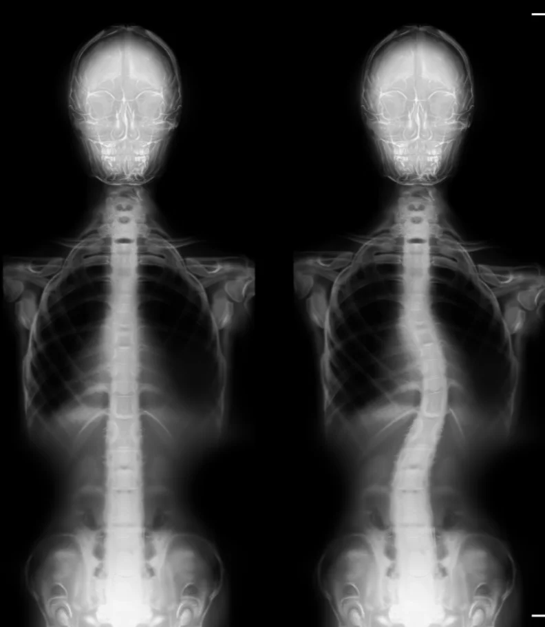 Scoliosis Randolph